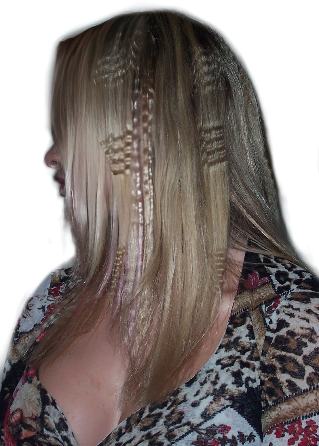 After Picture - Traction Alopecia Caused By Human Hair Extensions